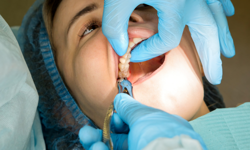 4 things you need to know about Wisdom Teeth Removal in Portland