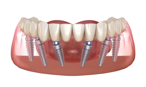 All-On-6 Dental Implants in portland