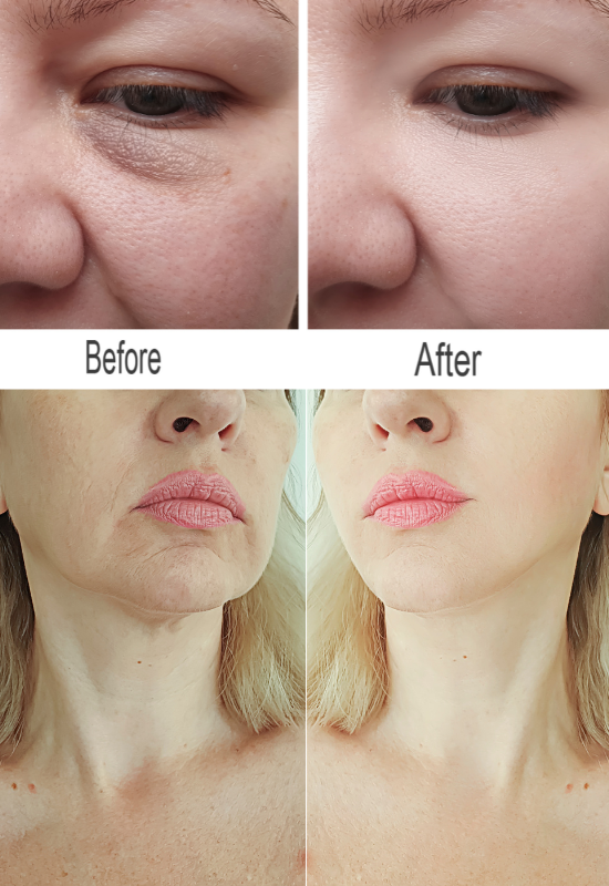 Facial Wrinkle Removal Process