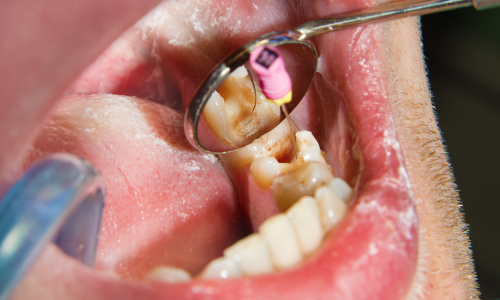 Root canal after care