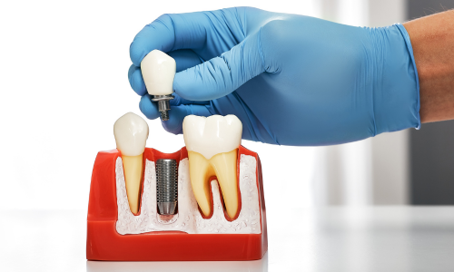 Zygomatic dental Implants in portland