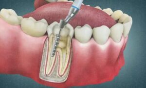 his guide aims to provide clear and complete information about root canal therapy, helping you understand the process, its benefits, and the associated recovery timeline.