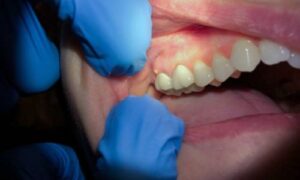 A tooth abscess bursting at home can be a discomforting and concerning experience. However, knowing what to do next is crucial for comfort and oral health.